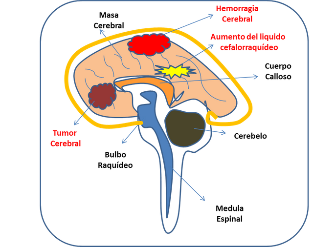 Hipertensión intracraneal presión arterial